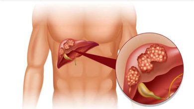 صورة تستدعي زيارة الطبيب فورا.. 8 علامات غير عادية لـ سرطان الكبد