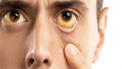 صورة يرقان الجسم دليل على أمراض خطيرة.. احذر هذه العلامات