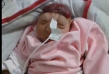 صورة حالة صادمة بغزة.. ولادة طفلة “بلا دماغ” ومطالب بالتحقيق في أسلحة “إسرائيل” (فيديو)