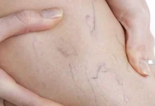 صورة دراسة تكشف العلاقة بين الدوالي ومشكلات الذاكرة