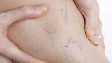 صورة دراسة تكشف العلاقة بين الدوالي ومشكلات الذاكرة