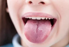صورة لسانك يكشف أسرار صحتك.. طبيبة تحذر من علامات تنذر بأمراض خطيرة