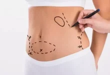 صورة احذر ..  اضرار شفط الدهون بكميات كبيرة من الجسم