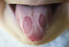 صورة تظهر على اللسان.. احذر هذه العلامات تكشف الإصابة بالسرطان