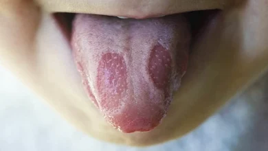 صورة تظهر على اللسان.. احذر هذه العلامات تكشف الإصابة بالسرطان