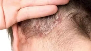 صورة “روفلوميلاست”.. رغوة زوريف الموضعية قد تعالج الصدفية