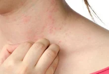 صورة متى يكون الطفح الجلدي على الوجه خطيرا؟ اذهب للطبيب فورا