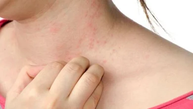 صورة متى يكون الطفح الجلدي على الوجه خطيرا؟ اذهب للطبيب فورا