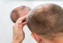 صورة في هذه الحالة تساقط الشعر يدل على الإصابة بعدوى خطيرة