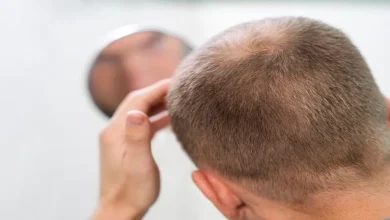 صورة في هذه الحالة تساقط الشعر يدل على الإصابة بعدوى خطيرة