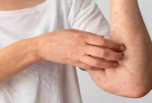 صورة علماء يطورون نموذج ذكاء اصطناعي لتشخيص الإكزيما