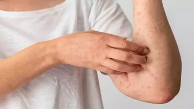 صورة علماء يطورون نموذج ذكاء اصطناعي لتشخيص الإكزيما