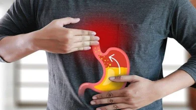 صورة ارتجاع المريء.. إليك الأسباب والأعراض والعلاج