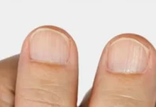 صورة علامة على الأظافر تكشف إصابة امرأة بهذا النوع من السرطان