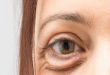 صورة تدلي الجفون.. إليك الأسباب وطرق العلاج