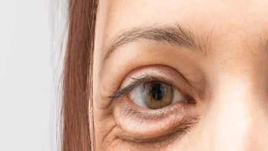 صورة تدلي الجفون.. إليك الأسباب وطرق العلاج