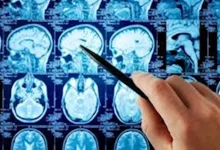 صورة اختبار جديد يسرع تشخيص أورام الدماغ في ساعتين بدلا من 8 أسابيع