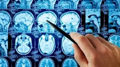صورة اختبار جديد يسرع تشخيص أورام الدماغ في ساعتين بدلا من 8 أسابيع