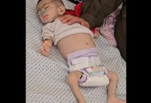 صورة استشهاد طفلة في غزة بسبب المجاعة ما يرفع الحصيلة إلى 54