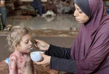 صورة المرض ينهش جسد الطفلة نور على وقع القتل والمجاعة في غزة