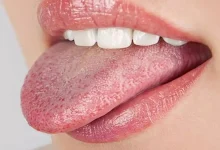 صورة احذر.. علامات على اللسان قد تكشف أمراضا خطيرة