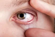 صورة راقب عينيك.. 5 أعراض غير عادية تكشف ارتفاع الكوليسترول