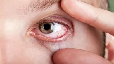 صورة راقب عينيك.. 5 أعراض غير عادية تكشف ارتفاع الكوليسترول