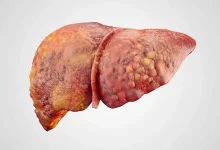 صورة 3 أشياء خطيرة تسبب تليف الكبد.. توقف عنها فورا