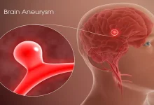 صورة احذر.. أعراض محتملة لـ تمدد الأوعية الدموية