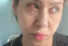 صورة بسبب خطأ طبي.. إيناس عز الدين تخضع لعملية عاجلة في العين