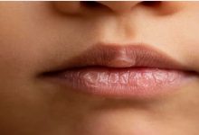 صورة 7 أسباب تؤدي إلى جفاف الفم