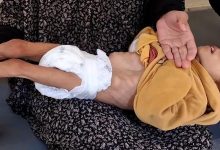 صورة حالتا وفاة جديدتان نتيجة المجاعة وسوء التغذية في غزة