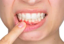 صورة لا تتجاهل نزيف اللثة.. قد يكون مؤشر لأمراض خطيرة