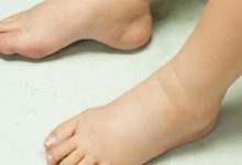 صورة ما أسباب وأعراض الوذمة؟