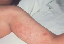 صورة الحصبة تنهي حياة طفل في بريطانيا