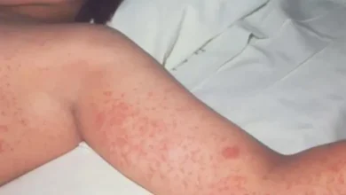 صورة الحصبة تنهي حياة طفل في بريطانيا