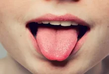 صورة احذر.. 5 عوامل تسبب سرطان اللسان