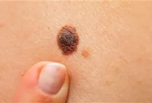 صورة أعراض خطيرة.. إصابة فتاة بالسرطان بعد معانها من ألم في هذه المنطقة