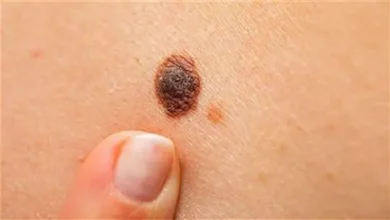 صورة أعراض خطيرة.. إصابة فتاة بالسرطان بعد معانها من ألم في هذه المنطقة
