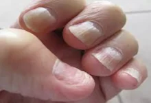 صورة لا تلاحظها بسهولة.. 5 أعراض تدل على الإصابة بسرطان الأظافر