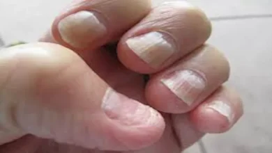 صورة لا تلاحظها بسهولة.. 5 أعراض تدل على الإصابة بسرطان الأظافر