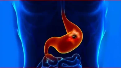 صورة 7 حالات لعمل فحص جرثومة المعدة