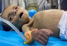 صورة الأونروا: ارتفاع معدلات سوء التغذية في غزة