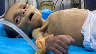 صورة الأونروا: ارتفاع معدلات سوء التغذية في غزة