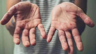 صورة 40 حالة إصابة بجدري القرود خلال 2025 في هذا البلد