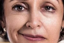 صورة تشنجات نصف الوجه كاضطراب عصبي.. تعرف على أسبابه وطرق علاجه