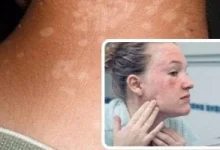 صورة متلازمة الجلد المحروق.. تعرف على معناها وطرق التعامل معها