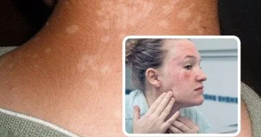 صورة متلازمة الجلد المحروق.. تعرف على معناها وطرق التعامل معها