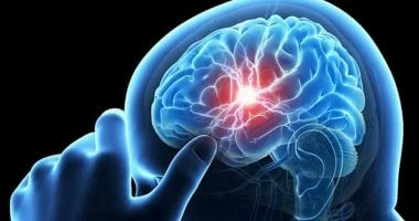 صورة أسباب تكون جلطات الدم في الدماغ وعلاماتها التحذيرية وطرق الوقاية