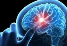 صورة أسباب تكون جلطات الدم في الدماغ وعلاماتها التحذيرية وطرق الوقاية
